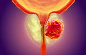 تضخم البروستاتا